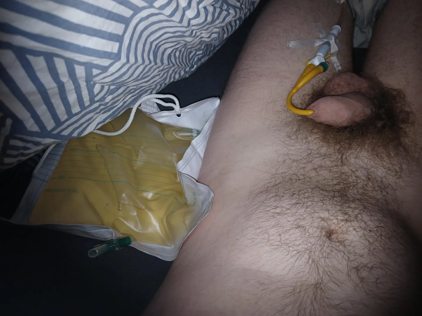 first time catheter with a night bag full of piss