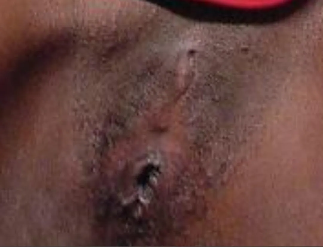 Beautiful lipless skin and hole