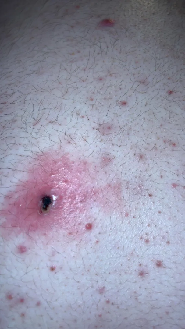 concerned about this on my back i think it's a pimple scabbed over but unsure