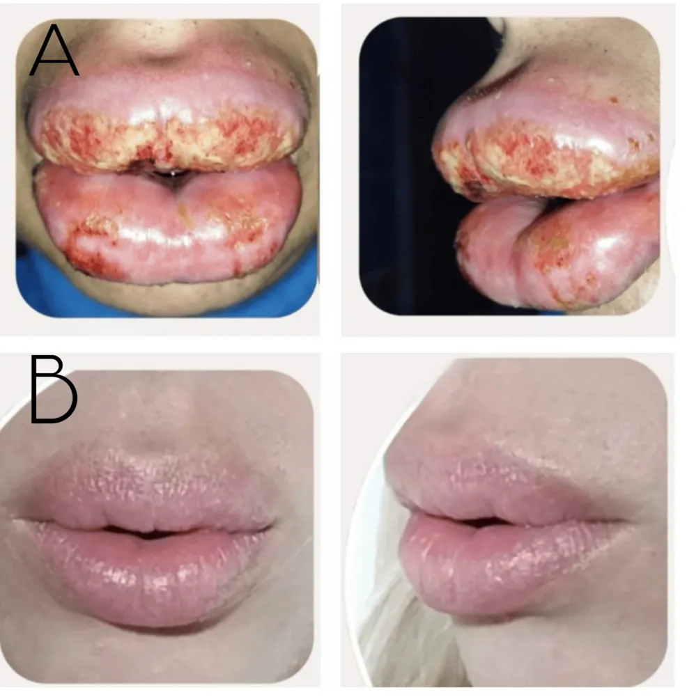 Angioedema and bacterial and viral Infection following hyaluronic acid fillers injection to the lips