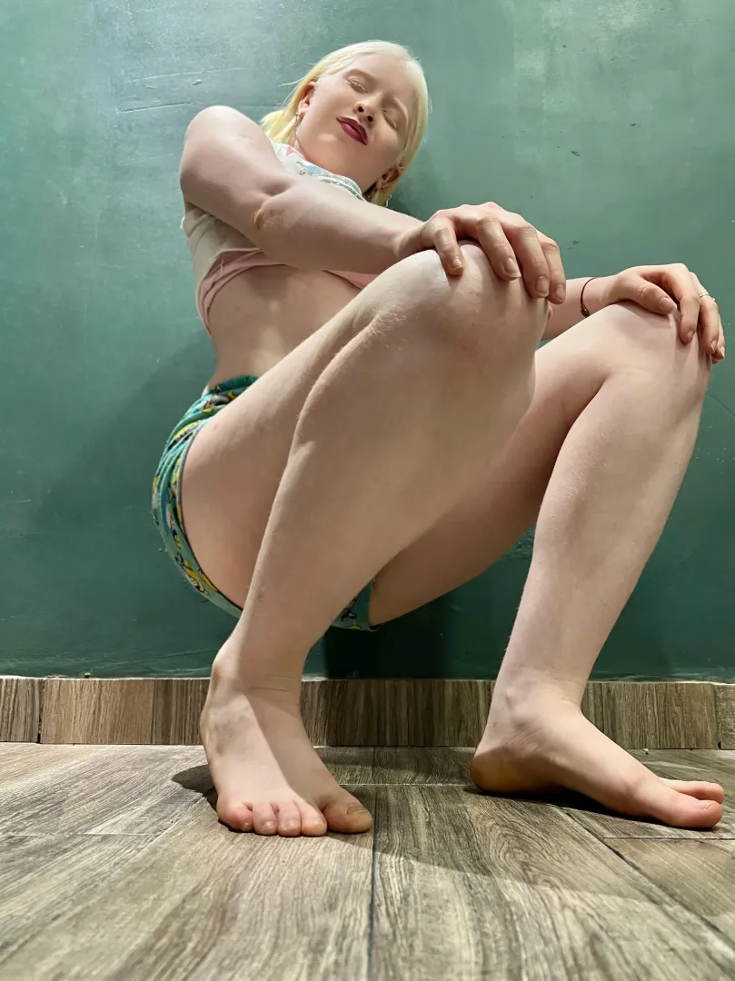 What would you rate my albino legs