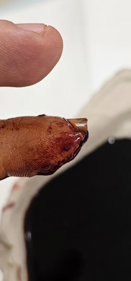 I cut the tip of my finger off at work