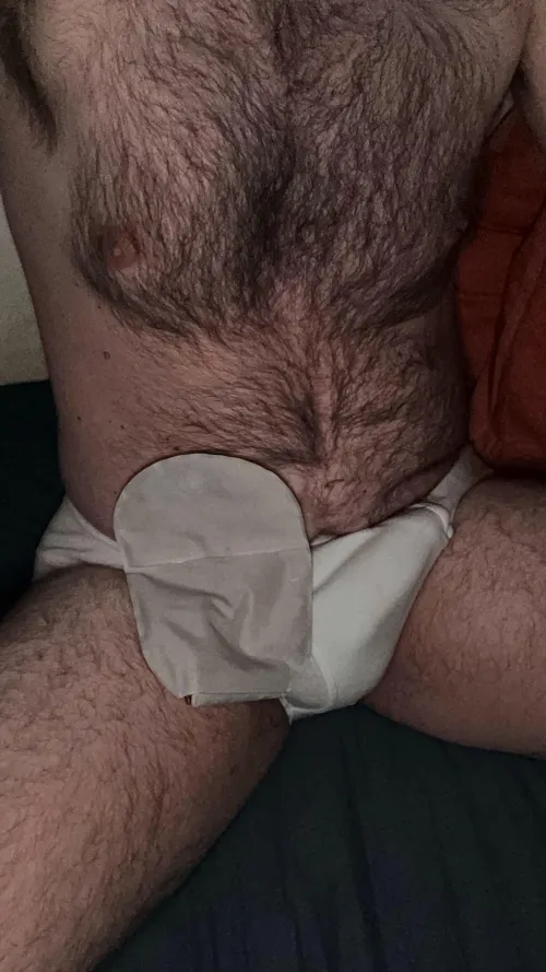 40m ostomy