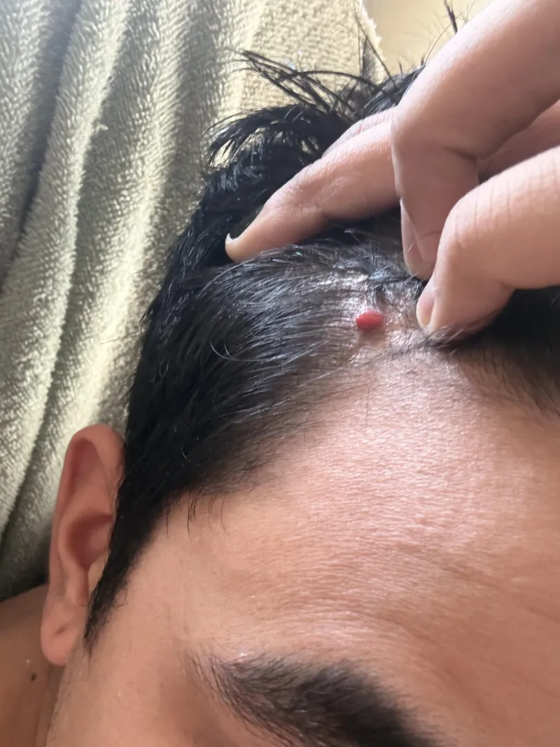 Is this a cherry angioma, it doesn’t hurt at least I press it really hard