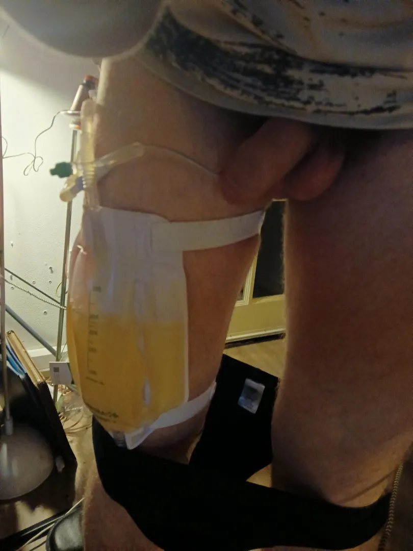 Now it wil not go as planned the doctor was trying today of i can pee on my one without a catheter is goes horribly wrong and now I have a new one inserted en must go to the uroloog in the hospital