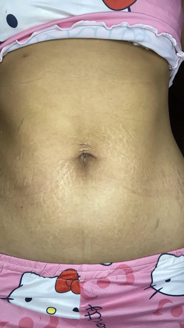 What shape do my stretch marks make on my belly?