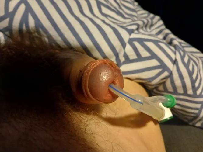 My dick its adapted to the catheter no open hole around the catheter 