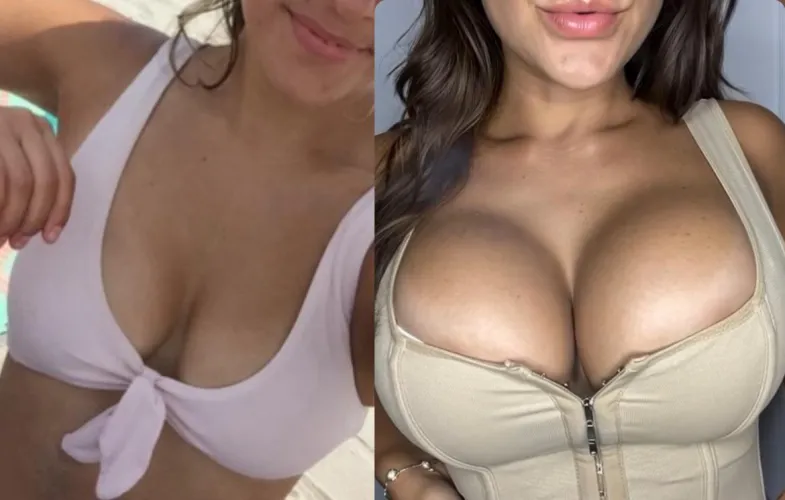 Fuller lips and bigger tits