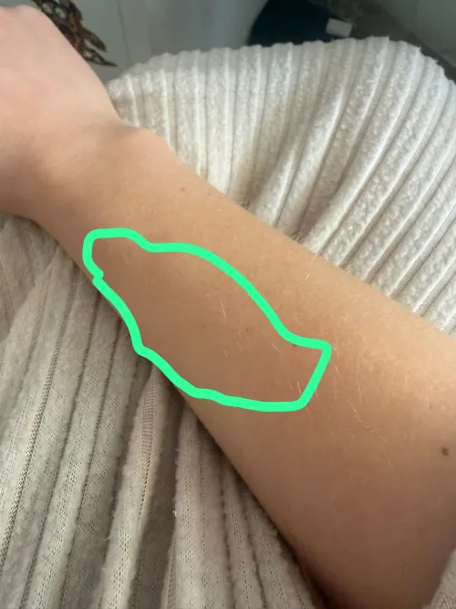 Numbness on forearm skin. I woke up yesterday with skin in the area numb, feels like pins and needles.