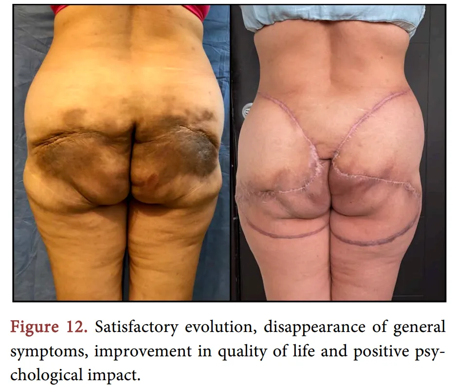 A woman got mineral oil injected in her buttocks for augmentation purposes. 30 years later she needed her butt reconstructed.