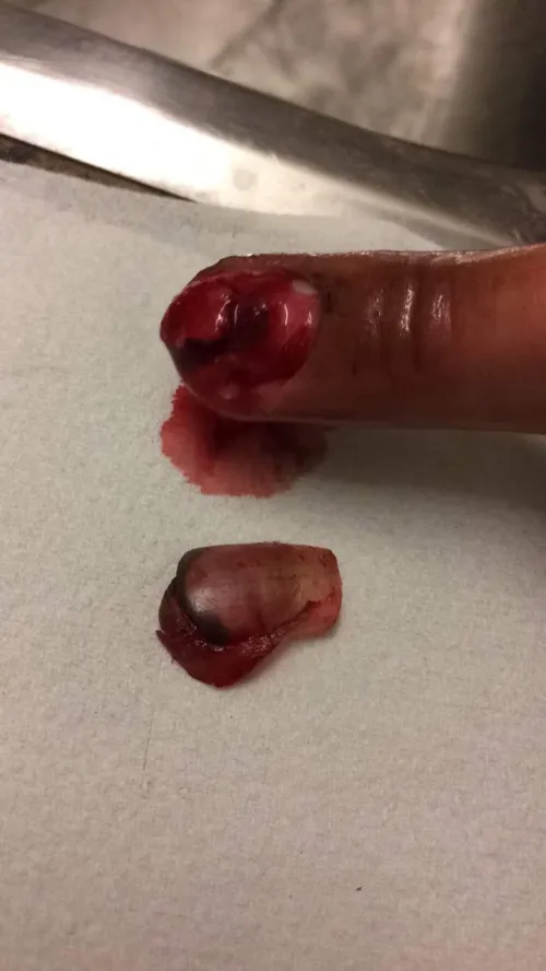 Smashed my finger while fueled with anger and energy drinks.