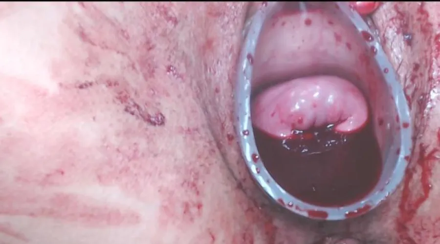 Cervix extreme blood