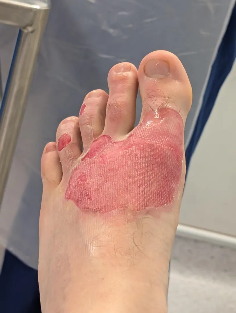 My new accident with boiling pasta