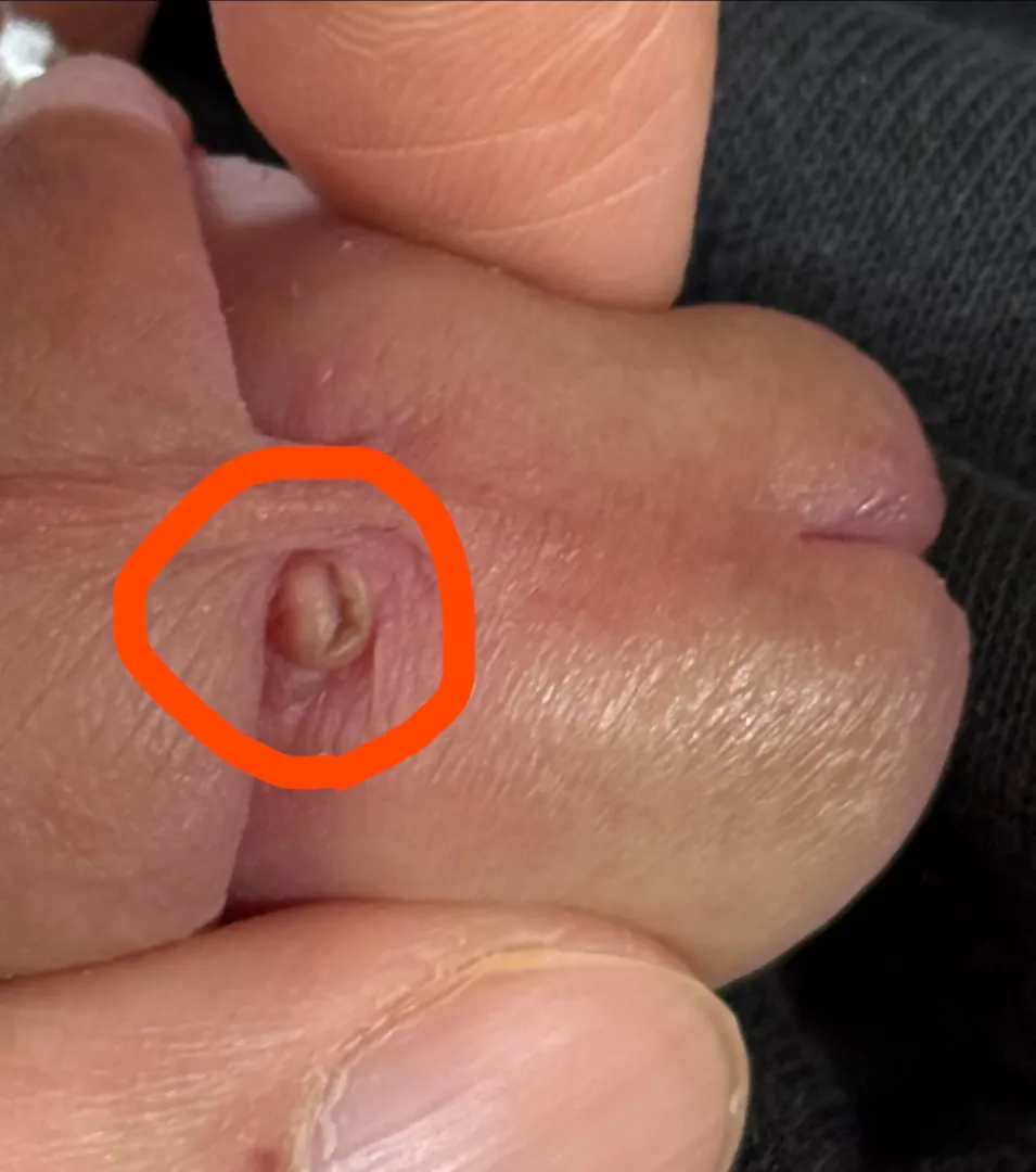 Scar tissue around PA