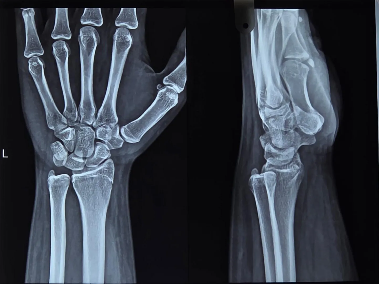 Cracked my wrist, when can I go to the gym and probably start lifting heavy