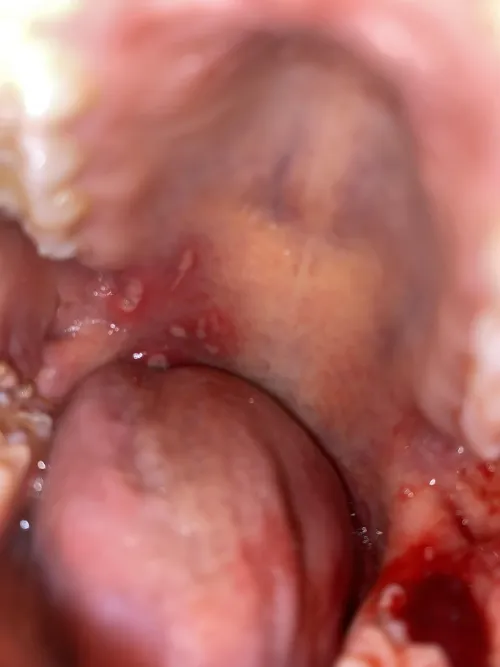 Injuries after a wisdom teeth removal surgery