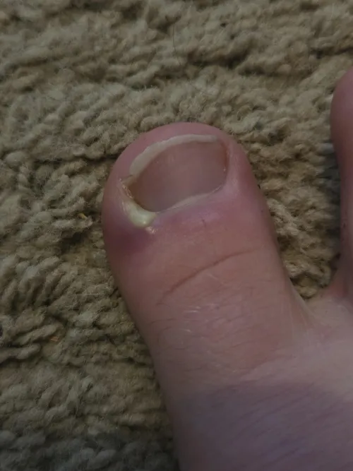 My toe has hurt the last day or so, this is what it looks like. What seems to be the issue here and what is my course of action?