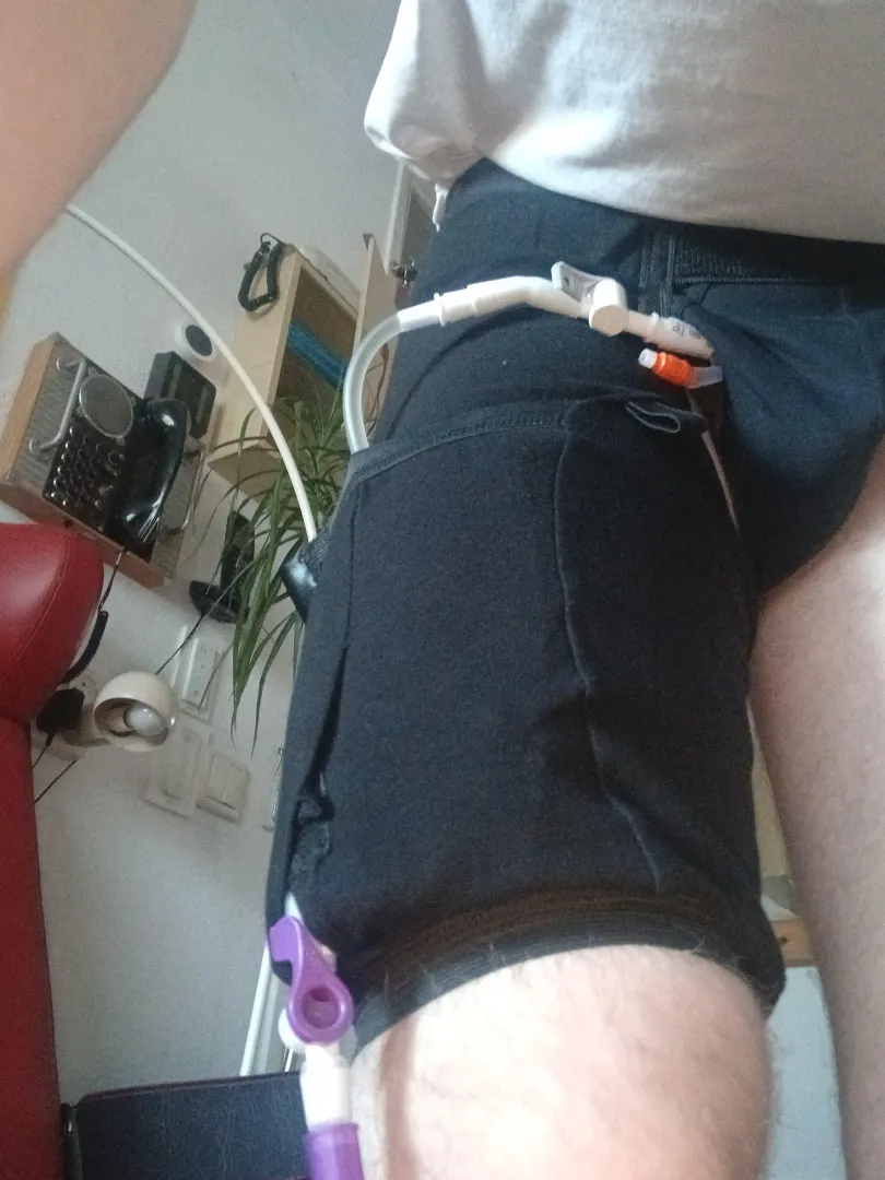 I have found a comfy leg bag day holder no irritation no nothing it hols every bag for the day that is square and have a adapte opening to every drain valve its around you waist supported and around your leg i have this 24/7 now on i have 2 time this thi
