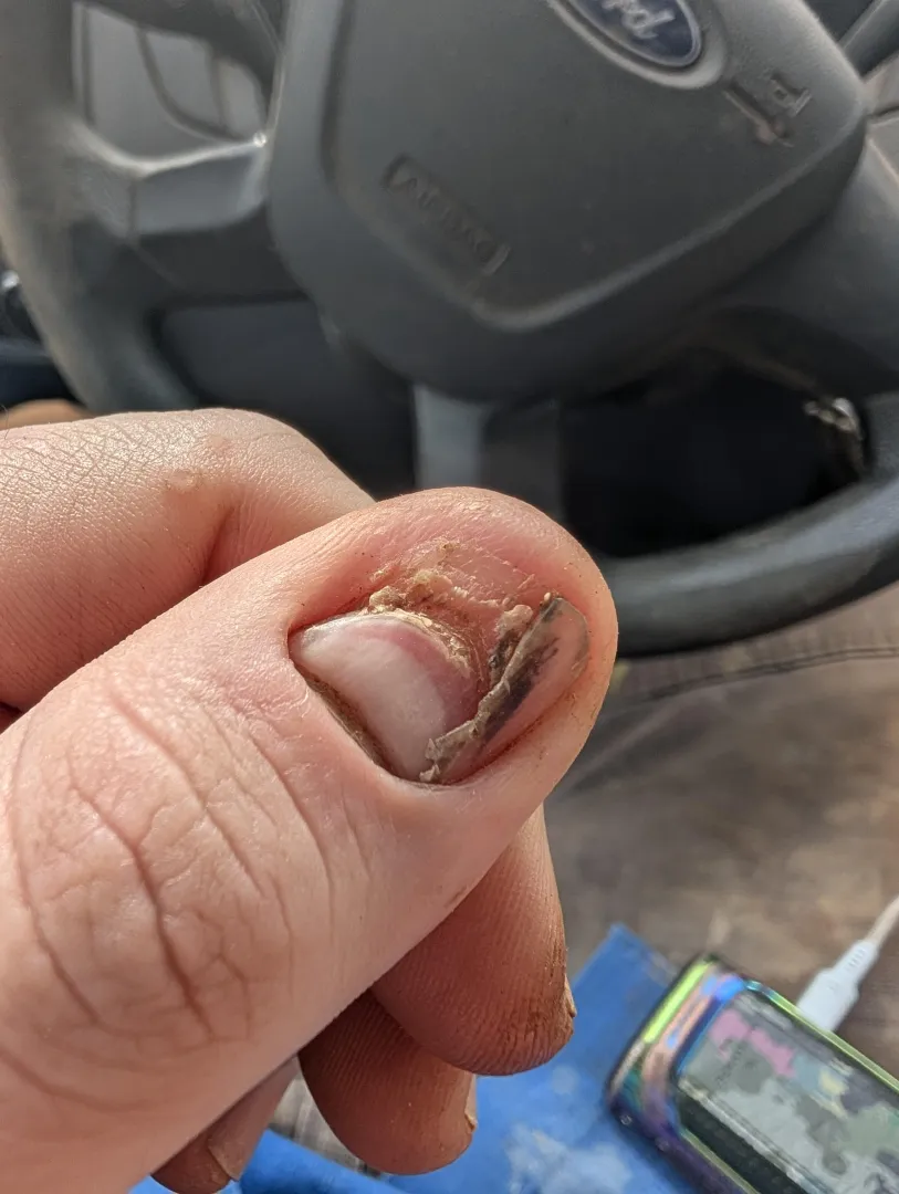 25day update on thumb