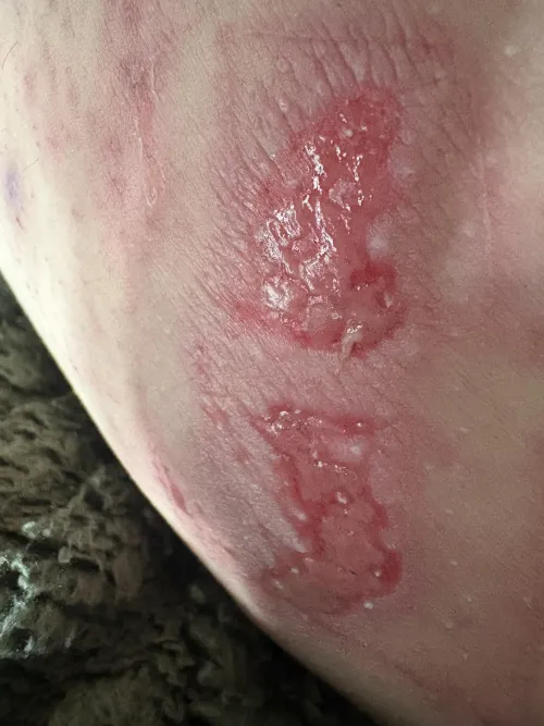 thigh chafing! (jeans became threadbare and i wore them anyway  my mistake)