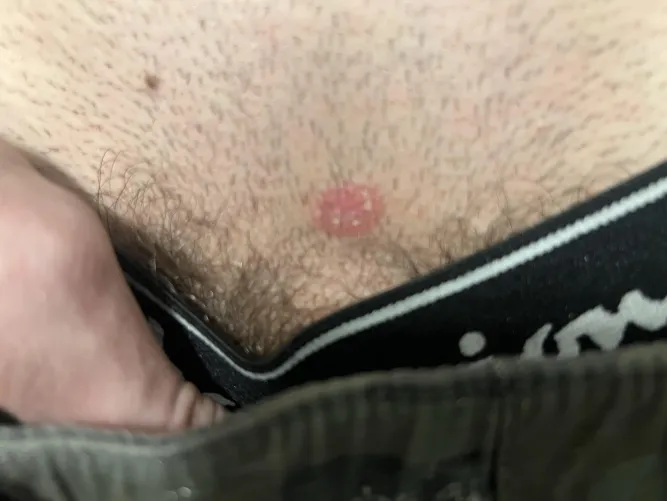18M, Not sexually active. Red patch near groin area for about a month now.