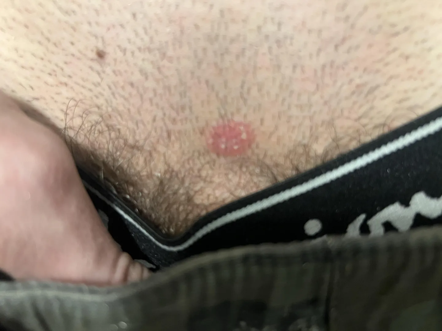18M, Not sexually active. Red patch near groin area for about a month now.