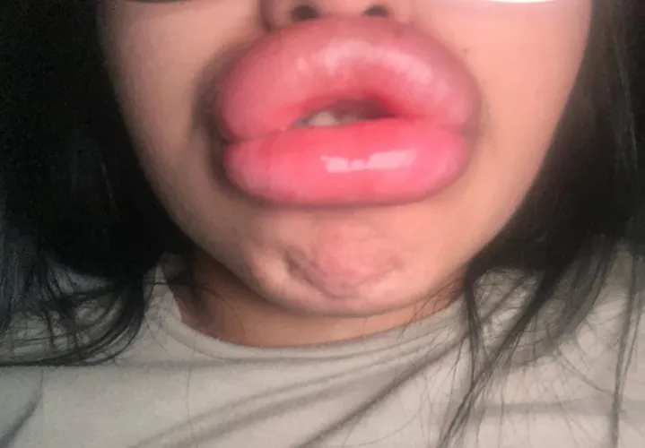 I urgently need fillers