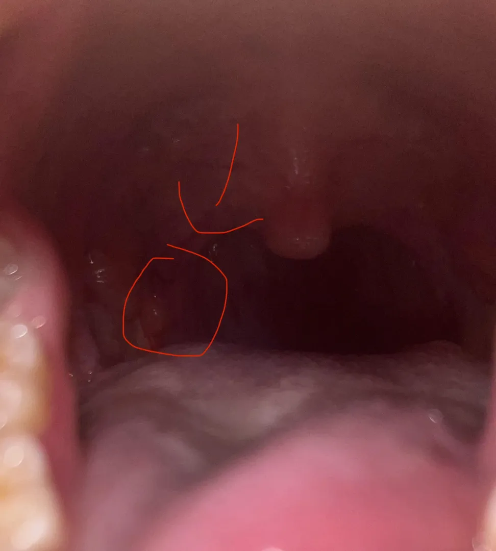 Lump near right tonsil flap idk what’s going on I’m scared ! Help