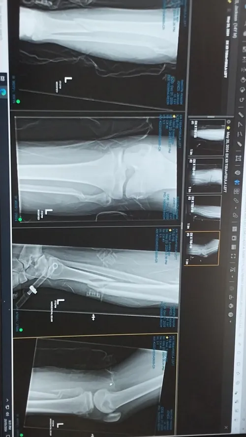 Broke my leg and while ago