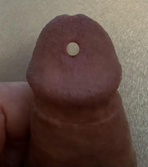 A hole in my glans!