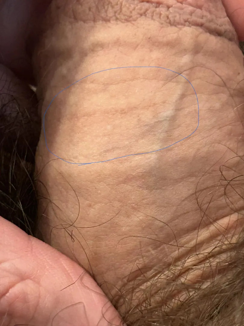 Is this a stretch mark or just a normal skin wrinkle?