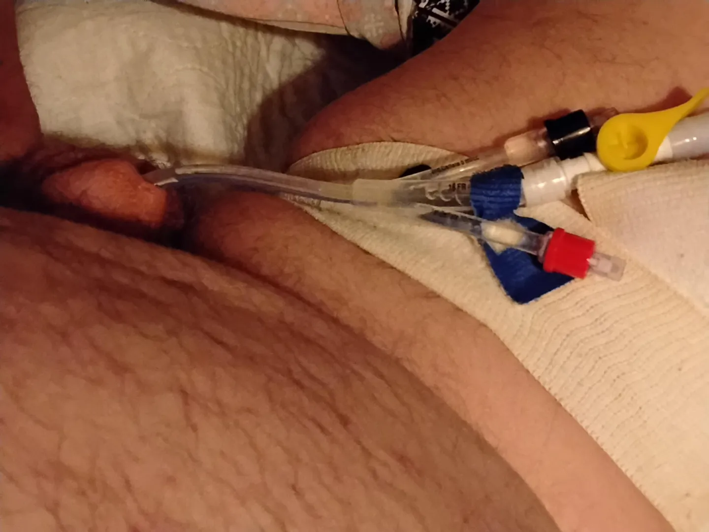 Late night addition. 18Fr trucath duo