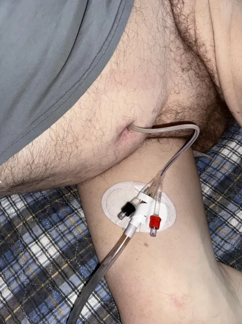 Supra public indwelling cathether, Fr 18.