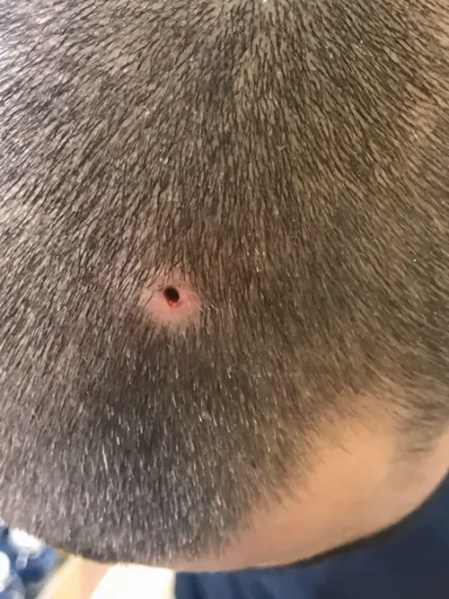 Head after removal of acne pus.