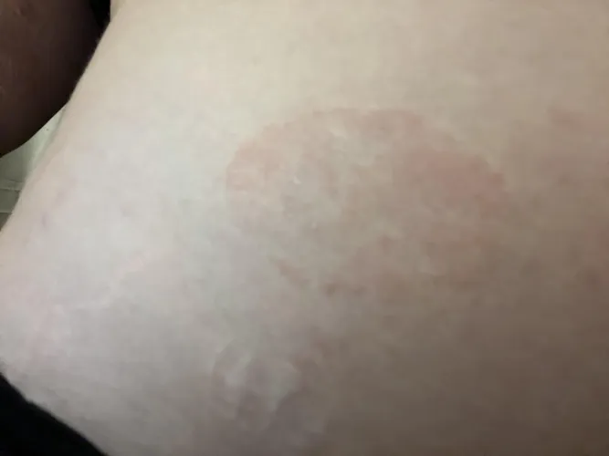 Could this be an allergic reaction, ringworm, or is it something else?