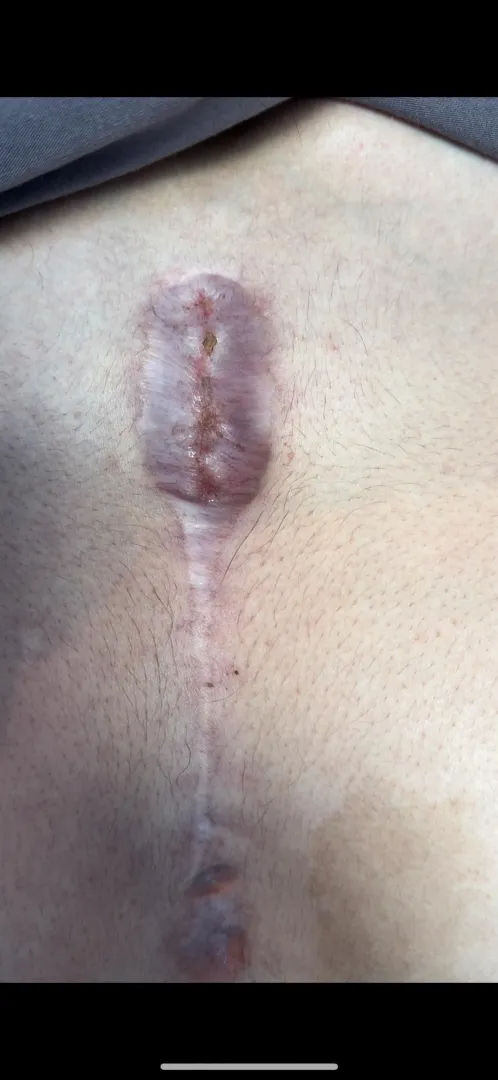 M25 Recurrent sternal wound dehiscence after multiple revisions and pectoral advancement (no clear cause despite extensive workup)