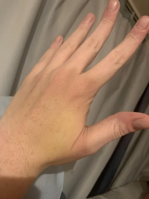 Noticed back of my hand looks yellowish, but nowhere else does (no yellow eyes either)
