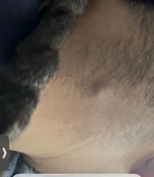 What dose this bump on the back of my neck look like. I’ve had it for a couple days