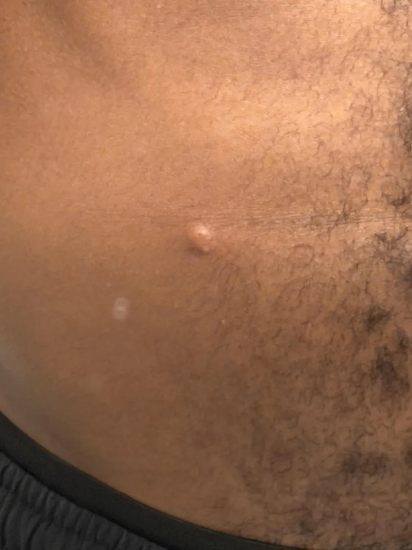 Bump Immediately After Injection