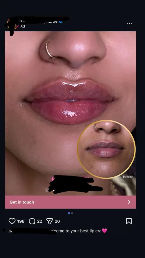 Terrible, lumpy filler advertised on IG