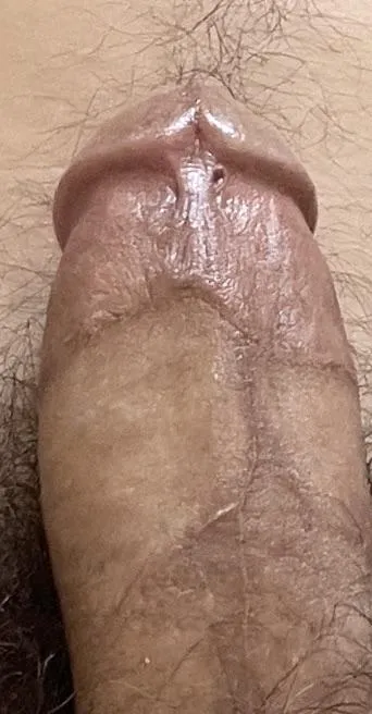 Crooked circumcision scar