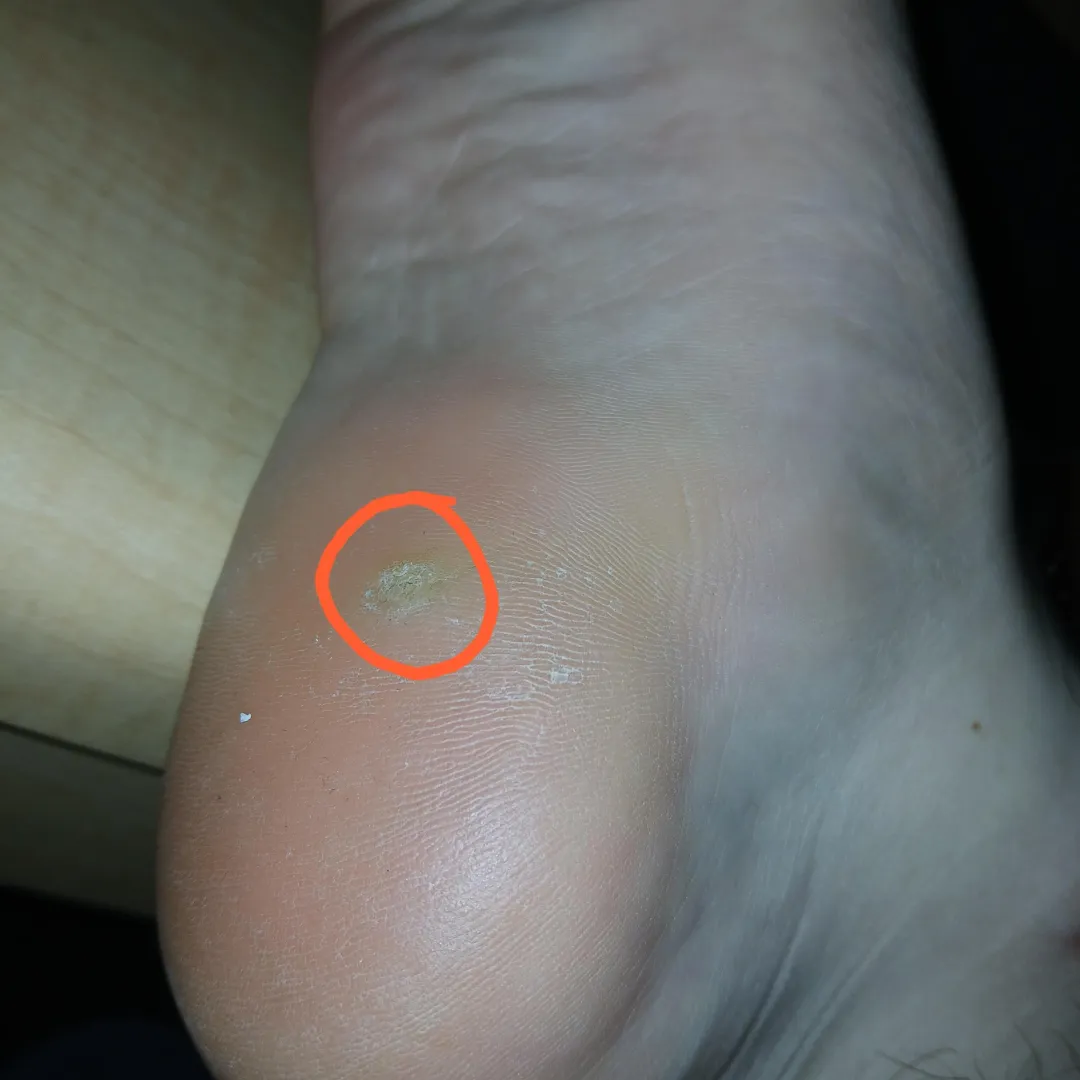I have this hard, circular thing on the bottom of my right foot. I don't know if it's a callus, a corn, or something else. What is it and what should I do?