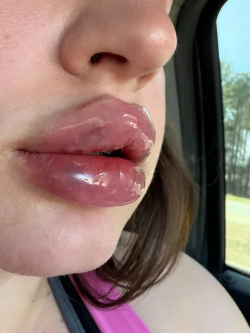 I went in to a lip filler appointment yesterday to get 2 more ML. When I got there she had another injector come in and tell me they wouldn’t do my lips, told me “I don’t even want to show you your side profile of your lips”, and said I should pu