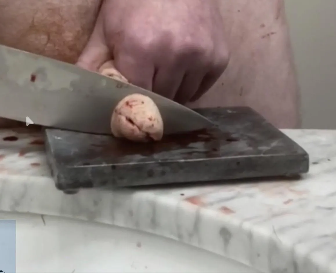 Glansectomy in progress