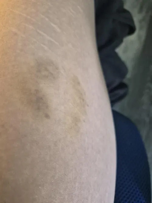Bite mark bruise on thigh
