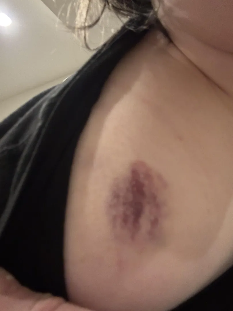 Human bite through a thick sweater.