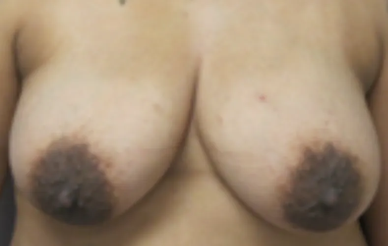 Big dark areolas
