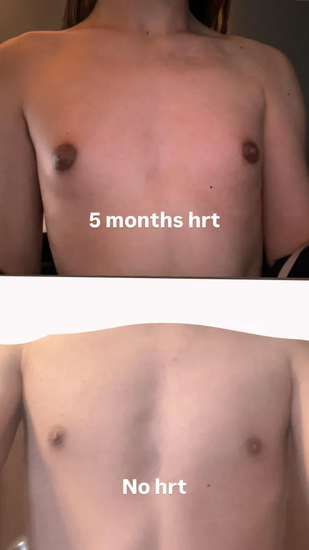 My growth was unfortunately not good.. 5 months hrt, EEn,started at 19