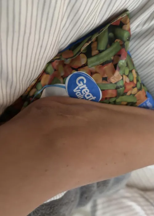 Slipped and tore tendon. Here it is on the wrong side of my elbow