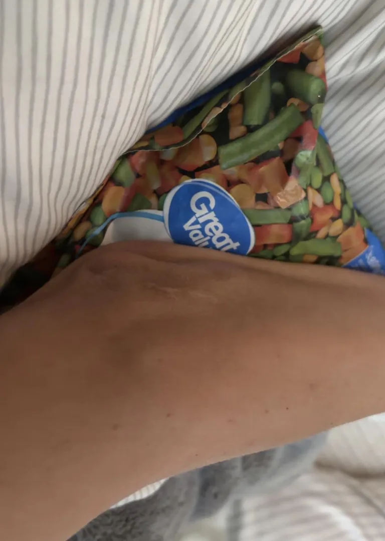 Slipped and tore tendon. Here it is on the wrong side of my elbow